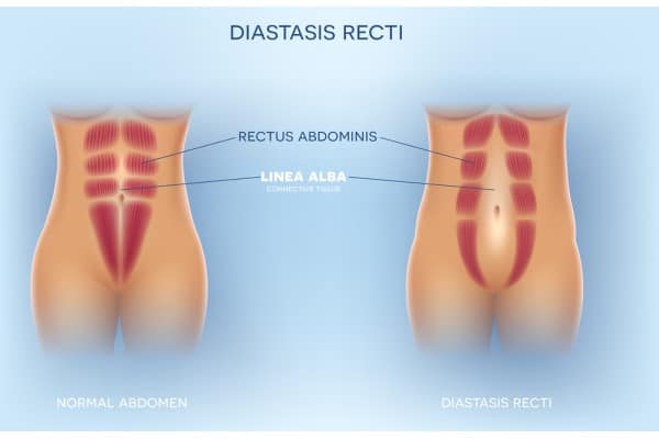 How Does Non-Surgical Treatment Help With Loose Skin, Weak Abdominal Muscles and Post-Pregnancy Changes Cranleigh?
