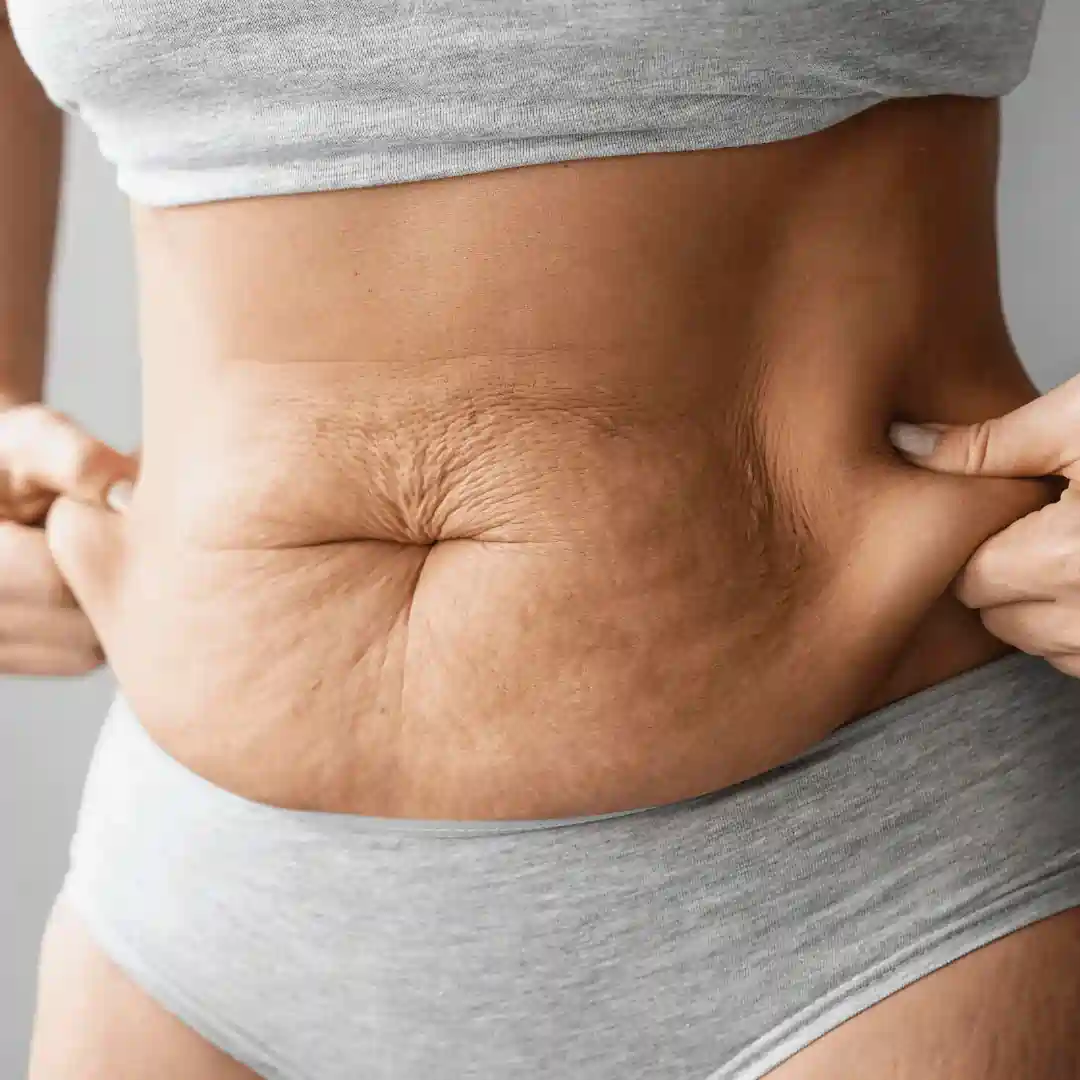 Is It Normal to Have Loose Skin After Pregnancy Cranleigh?