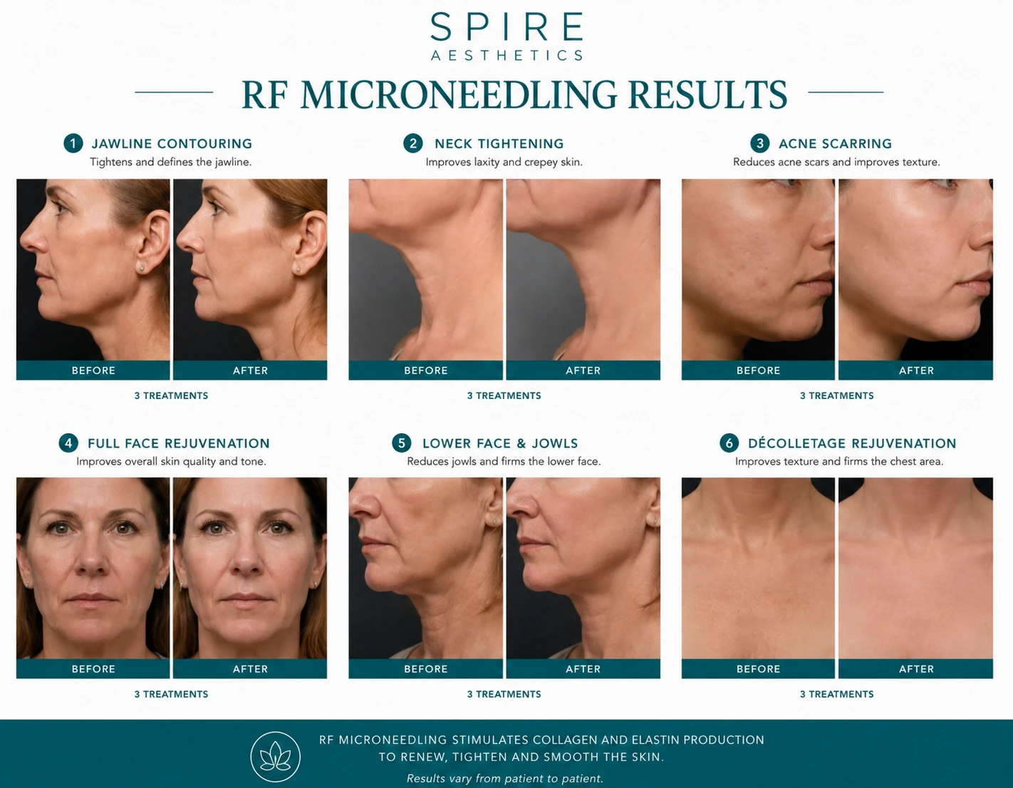 RF Microneedling Skin tightening Cranleigh results