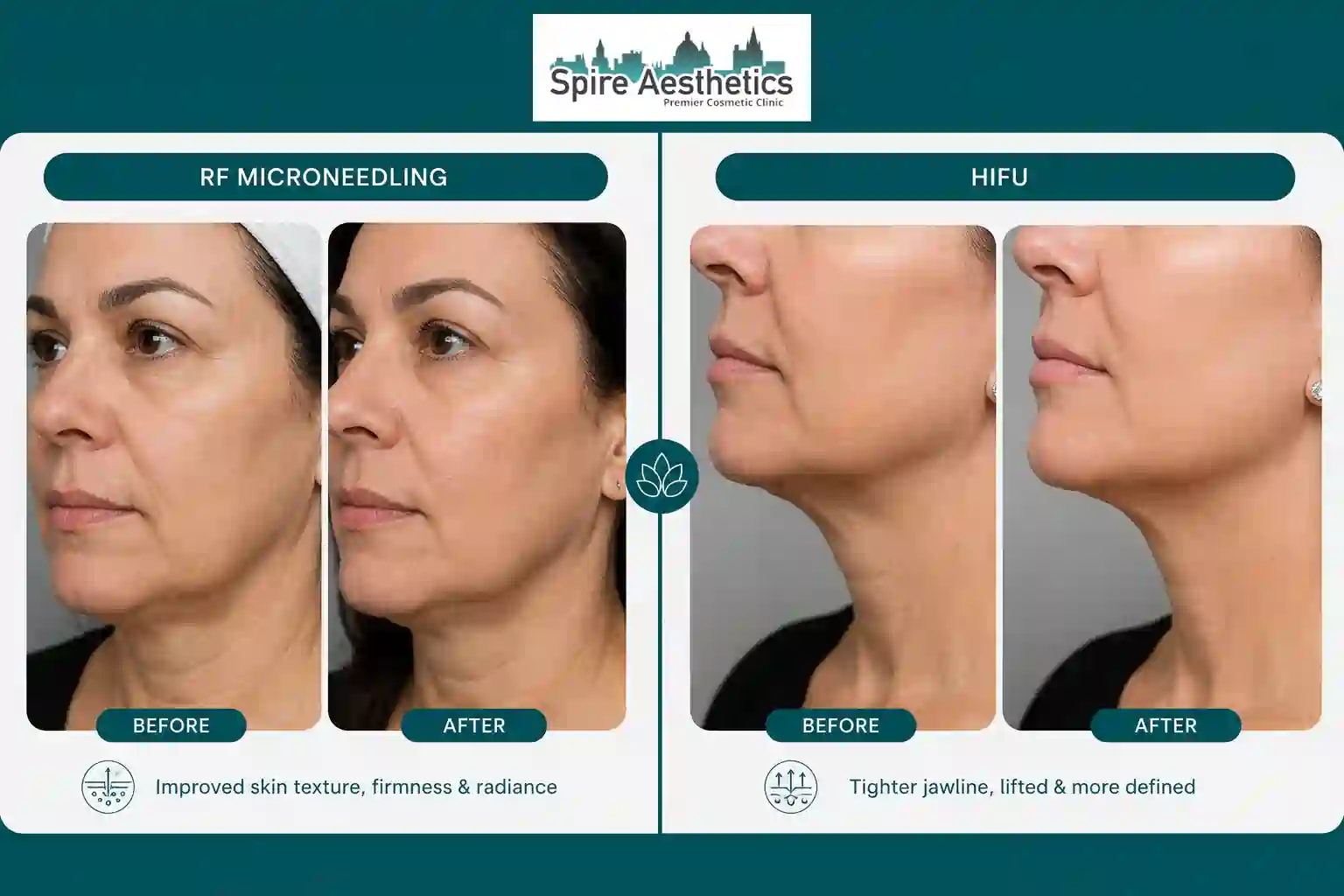 Can RF Microneedling and HIFU Be Combined Cranleigh?
