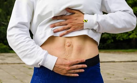 When Could Diastasis Recti Be the Missing Piece of the Puzzle Cranleigh?