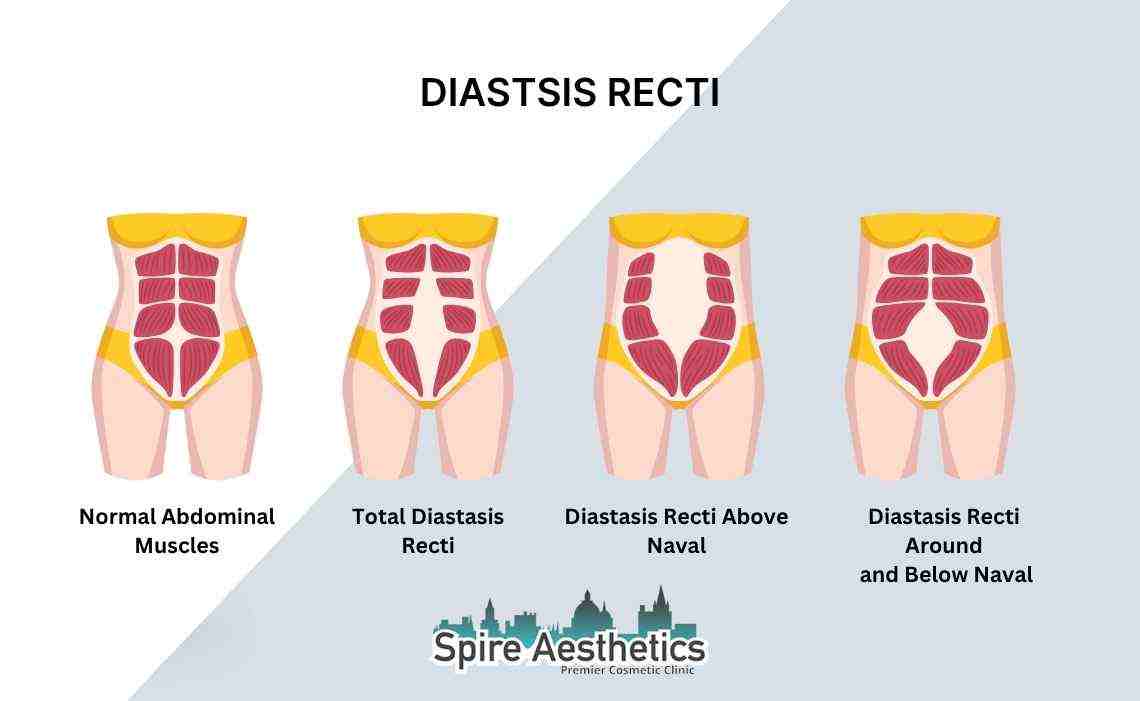 Is Non-Surgical Diastasis Recti Treatment Right for You? Common Concerns Answered Cranleigh